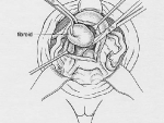 Illustration 2: Removing fibroids from normal uterine muscle