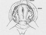 Illustration 3: Repairing the Uterus