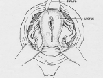 Illustration 3: Repairing the Uterus