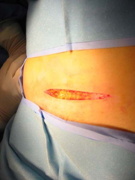 Picture of the incision