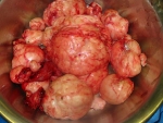 3-23-myomas