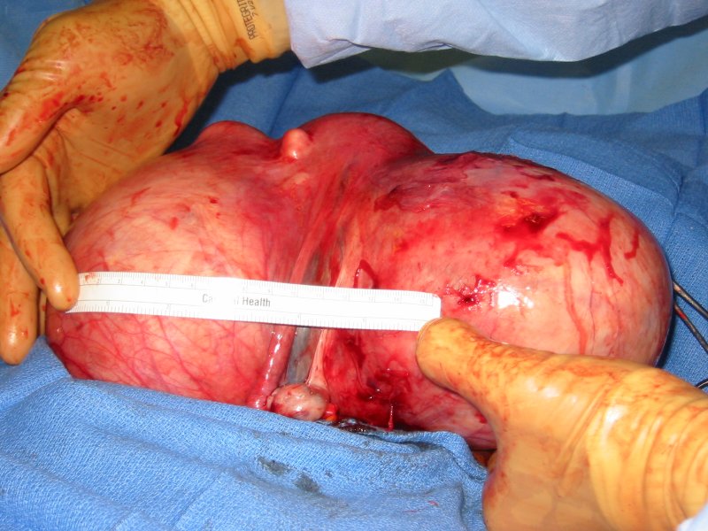 Uterus with fibroids prior to removal
