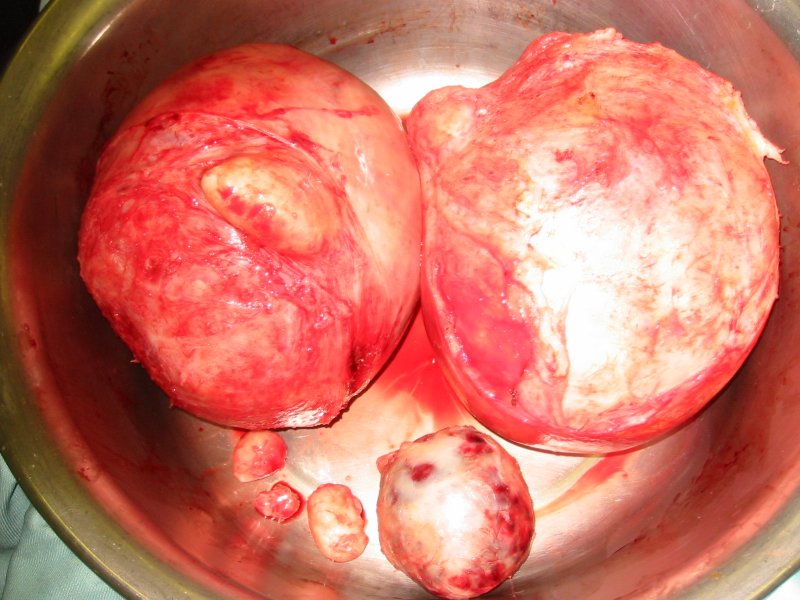 Fibroids after surgical removal by myomectomy