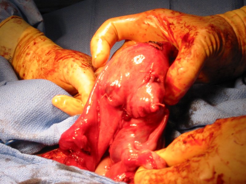 Uterus after myomectomy