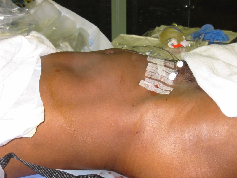 Post-op view of patient\'s abdomen after fibroids were removed