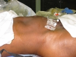 Post-op view of patient's abdomen after fibroids were removed