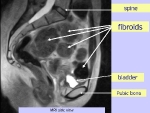 MRI Image of fibroids