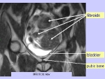 MRI Image of fibroids