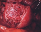 Adenomyosis Morcellation