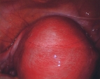 Uterus with Adenomyosis