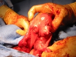 fibroids-removed-and-uterus-repaired