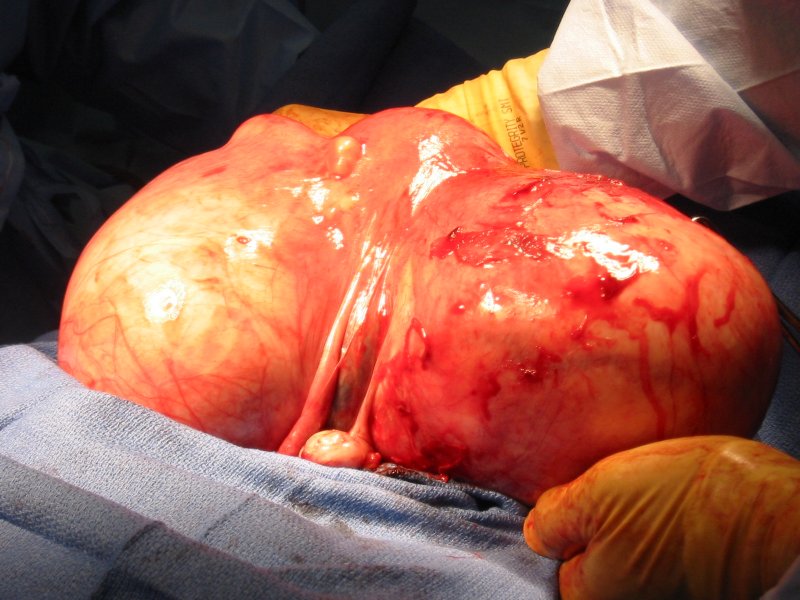 uterus-in-the-middle-of-two-large-fibroids