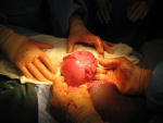 All fibroids have been removed and the uterus is repaired