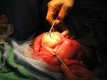 A fibroid is removed from inside the uterine cavity