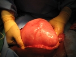 Uterus with multiple fibroids