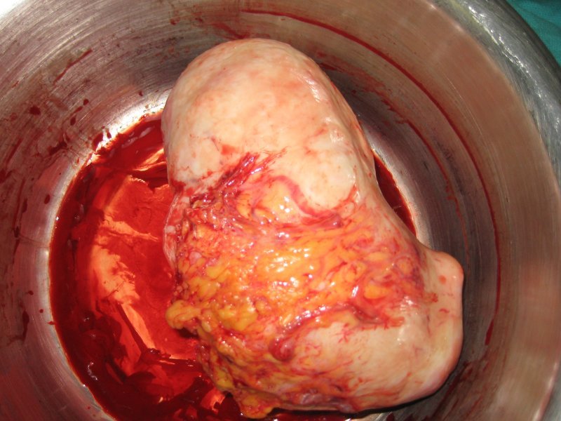 Fibroid with blood vessels from omentum fat pad around the intestines