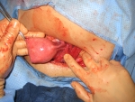 Fibroid removed and uterus repaired