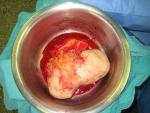 Fibroid with blood vessels from omentum fat pad around the intestines