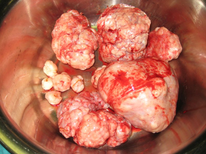 Removed fibroids