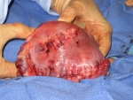 Fibroids removed and uterus repaired