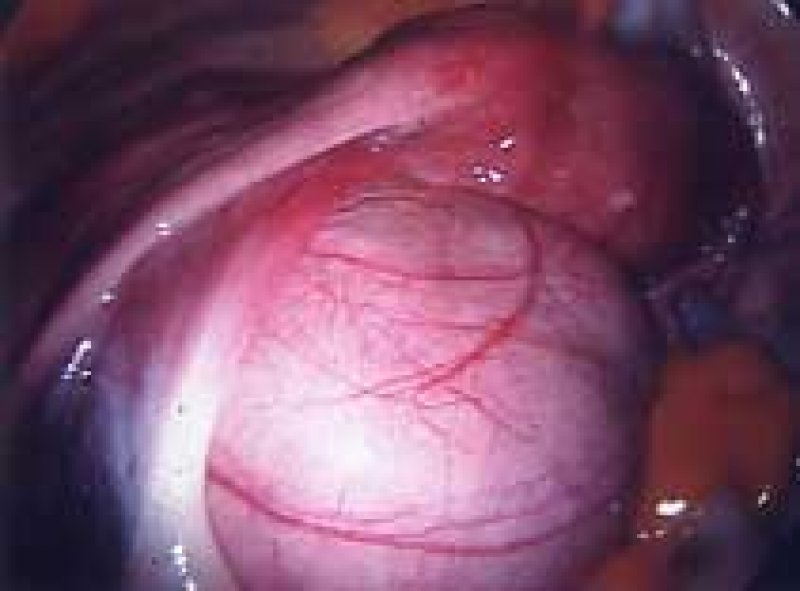 Fibroid on left and uterus on right