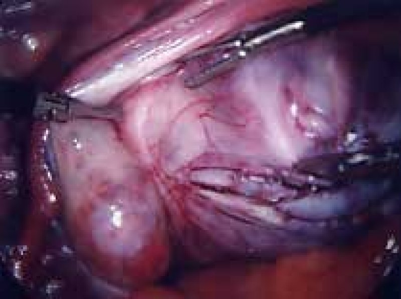 Removing fibroid near ureter