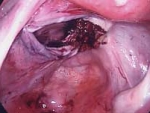 Fibroid attachment behind uterus