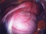 Fibroid on left and uterus on right