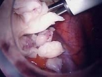 Morcellating fibroid