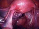Uterus repaired