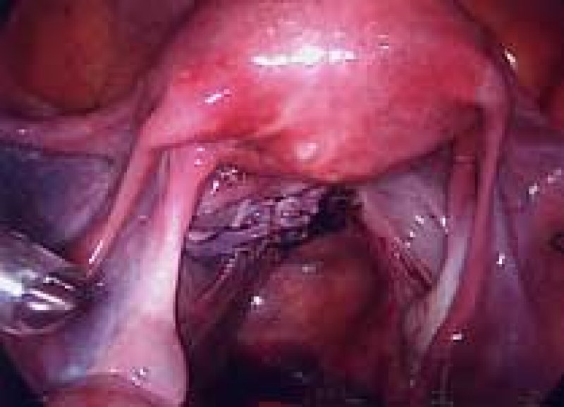 Uterus repaired