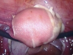 This adhesion barrier looks and feels like a silky piece of gauze. 