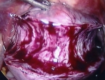 A portion of the fibroid has been removed by the morcellator.