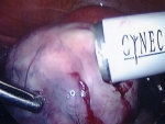The silver end of the morcellator is sharp and rotates quickly to cut through the fibroid.