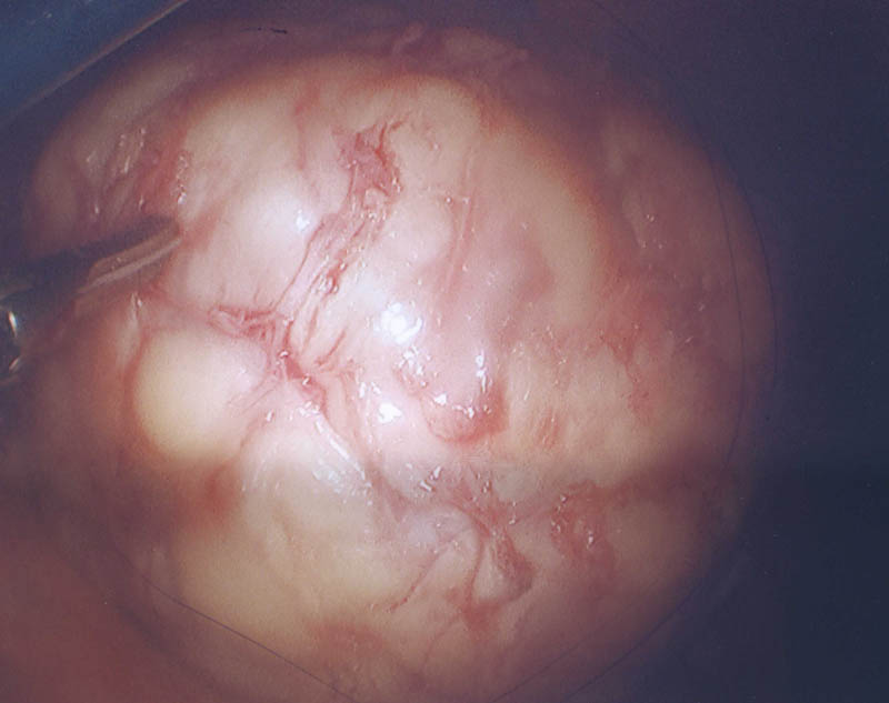 Fibroid after removal from uterus