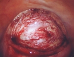 normal uterine muscle cut to reveal pale fibroid below