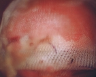 Uterus covered with Interceed adhesion barrier 