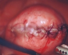 Uterus reconstructed with suture 