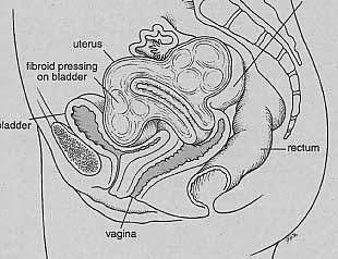 fibroid pressure