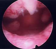 Before Hydrothermal Ablation (polyps can be seen at the top of the uterine cavity)
