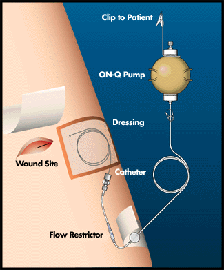 The ON-Q catheter is left under the incision and the pump is carried in a belt pack.
