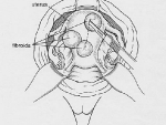 Illustration 1: Abdominal Myomectomy Incision