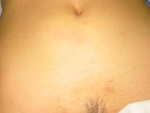 Picture of the abdomen prior to surgery