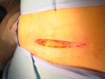 Picture of the incision