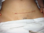 Picture of the incision 2 weeks after surgery