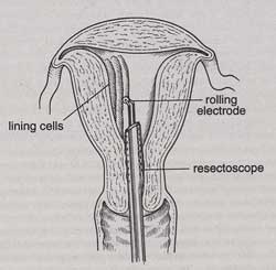 Roller Bar Endometrial Ablation