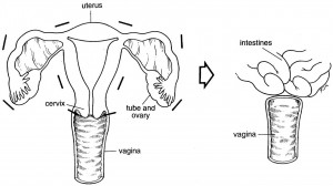 Removal of the ovaries and tubes, which is rarely a good idea, is called bilateral salpingo-oophorectomy. (Click on image for larger version)