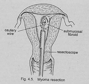 Hysteroscopic Myomectomy 