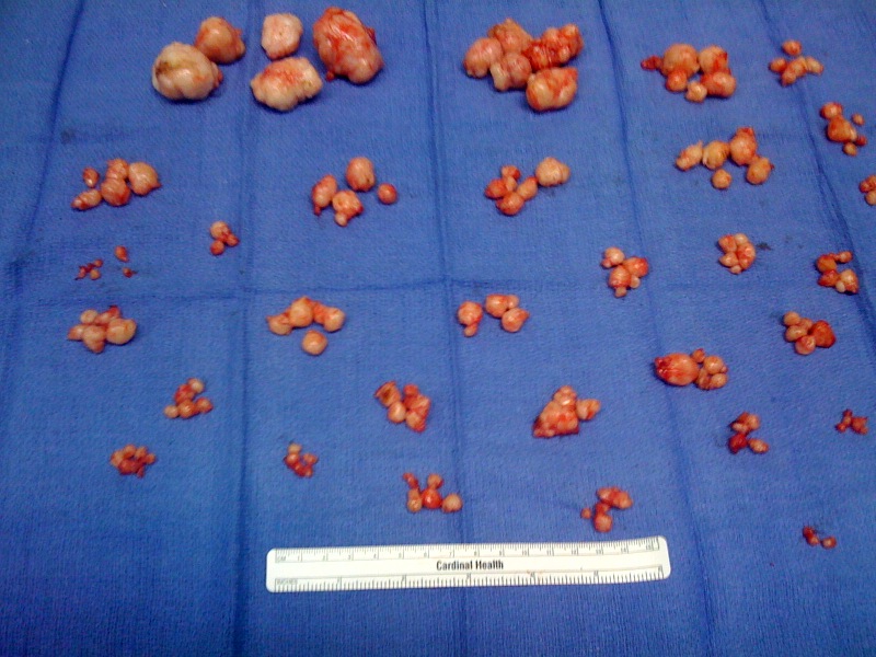 150 fibroids removed by abdominal myomectomy
