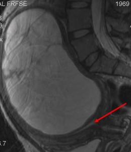 MRI shows the cyst within the uterine wall. Arrow points to the uterine cavity